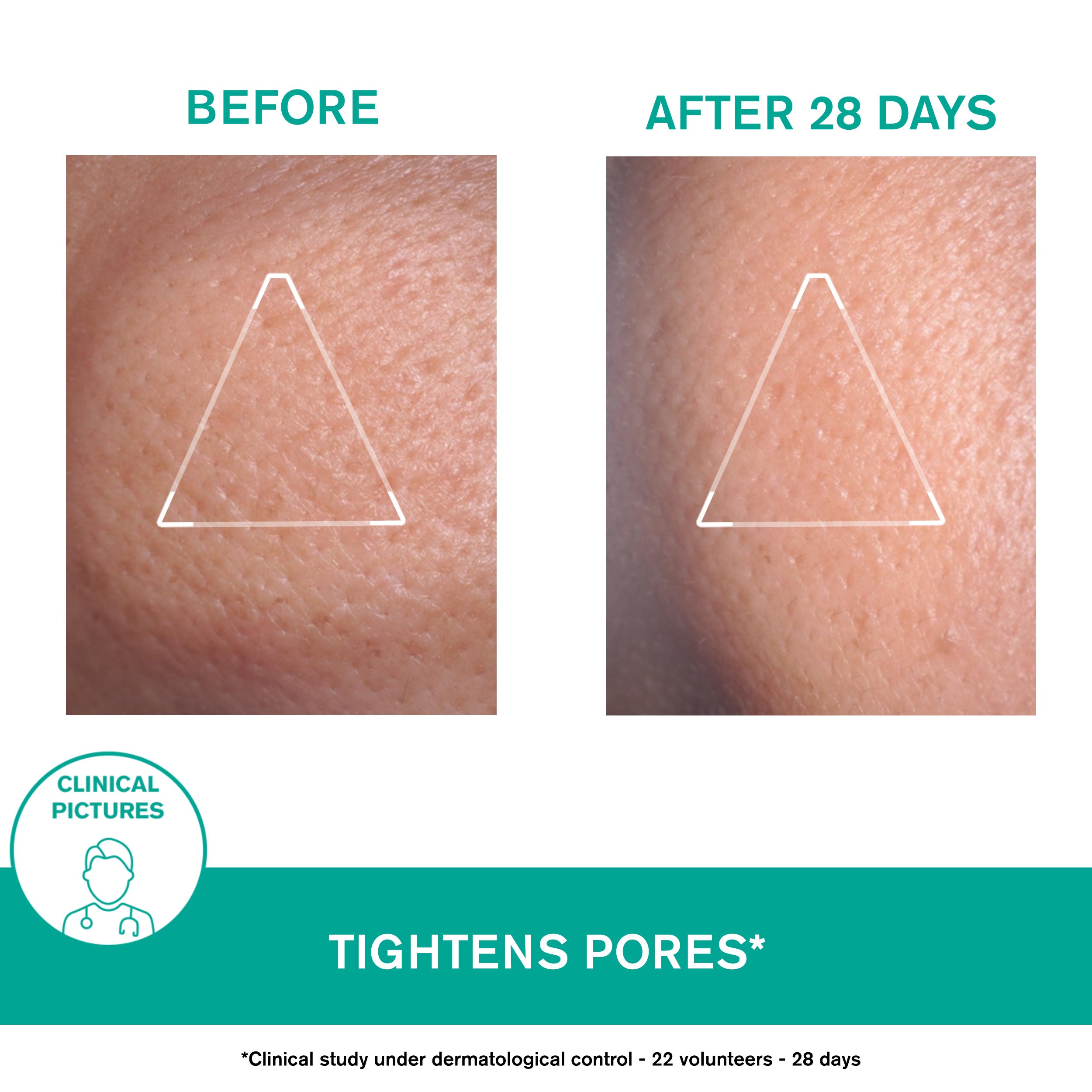 Uriage Hyséac Mattifying Gel-Cream before and after image