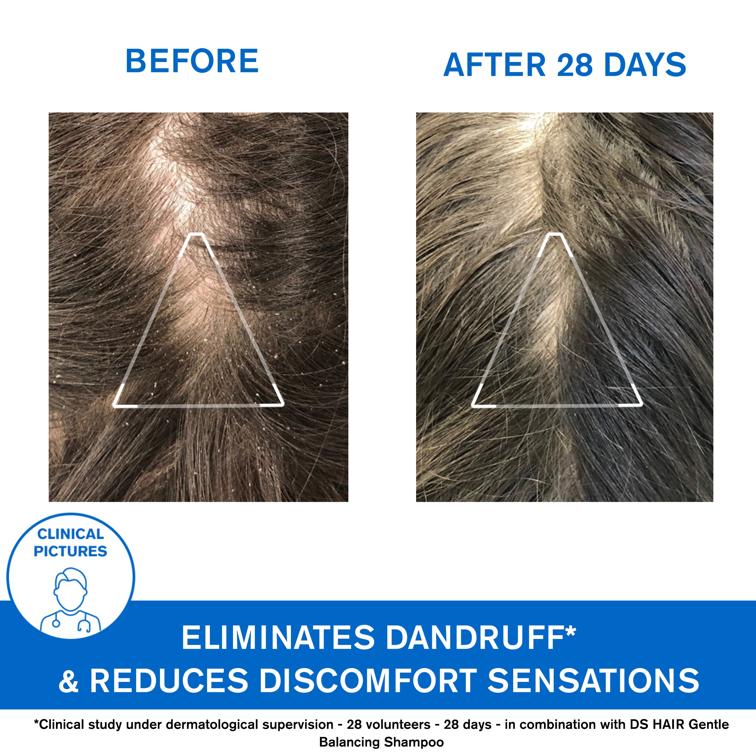 Uriage Ds Hair Anti dandruff Shampoo Result