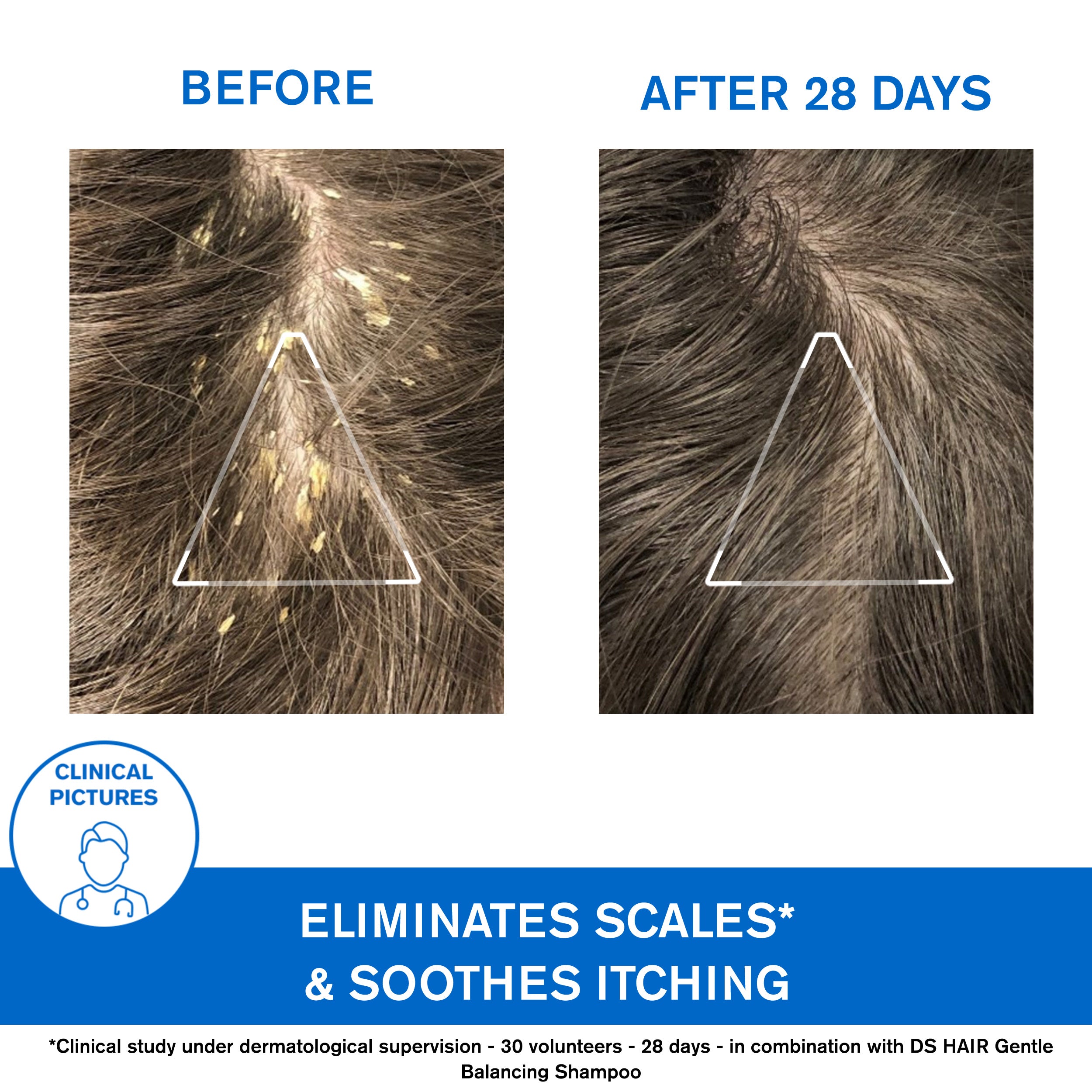 Uriage Ds Hair Kerato Reducing Shampoo results